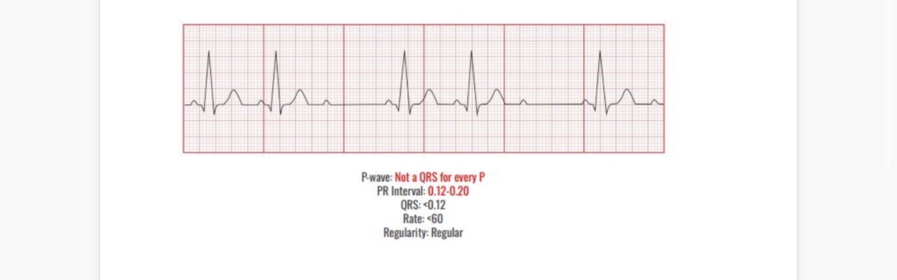 <p>Causes</p><p>Mi</p><p>Ischemia</p><p></p><p>Interventions</p><p>Pacing</p>