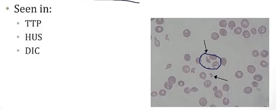 <p>-small vessels</p><p>-ADAMTS13; vWF</p><p>-autoantibodies</p><p>-MAHA; schistocytes</p><p>-neurological symptoms, fever, and petechiae</p>