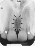 <p>Radiolucent line between maxillary central incisors</p>