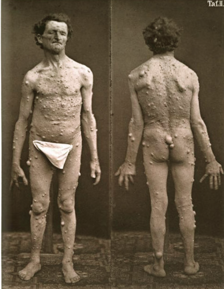 <p>An elevated cutaneous nodule that is asymptomatic</p><p></p>