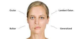 <p>Myasthenia Gravis </p>