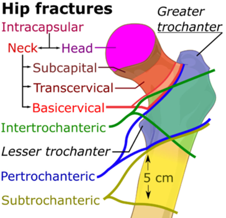 <p>What does this refer to</p><ul><li><p>Ball and socket joint</p><ul><li><p>Fracture AND/OR</p></li><li><p>Dislocate</p></li></ul></li><li><p>Types of hip fractures</p><ul><li><p>Intracapsular fractures</p></li><li><p>Extracapsular fractures</p></li></ul></li></ul><p></p>