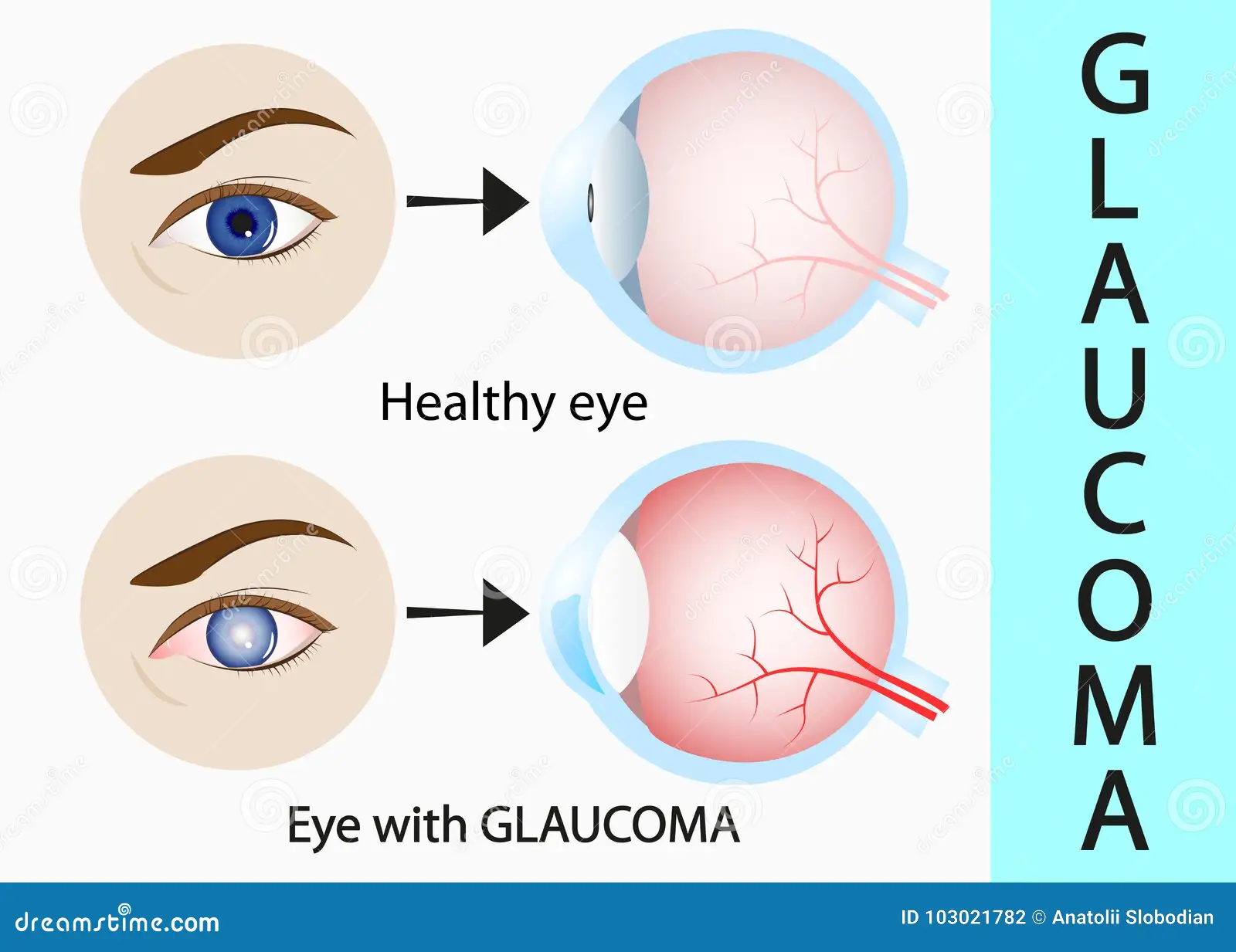 <ul><li><p>sprake van verlies aan zenuwvezels in de kop van de oogzenuw (de papil). Dit wordt vaak veroorzaakt door een <strong>verhoogde oogboldruk</strong>, doordat het kamervocht in het oog onvoldoende wordt afgevoerd. Ook een verminderde doorbloeding van de oogzenuw kan een rol spelen.</p></li><li><p><strong>Symptomen:</strong> Het <strong>perifere gezichtsveld</strong> (de zijkanten van wat je ziet) wordt geleidelijk aan kleiner. Omdat dit proces heel langzaam gaat, merken patiënten vaak pas in een laat stadium dat ze minder zien.</p></li></ul><p></p>