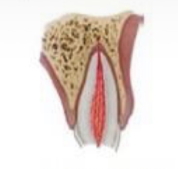 <p>Fracture confined to enamel and dentin with pulp exposure</p><p>Immature root and open apex- <strong>PRESERVE PULP- partial pulpotomy </strong>or <strong>pulp capping</strong></p><p>If completed root- be conservative, but if need post for crown retention- just do RCT</p><p>Place CaOH or calcium silicate cements in pulp wound</p><p>Rebond fragment or if absent- cover with GIC</p>