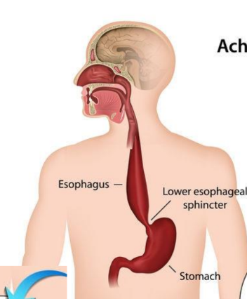 <p>(aka Cardiospasm). Motor disorder of the esophagus in which peristalsis is reduced along the distal 2/3 of the esophagus.</p>