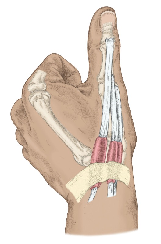 <p><span>abductor pollicis longus and brevis</span></p><p style="text-align: left;"><span>extensor pollicis longus and brevis&nbsp;</span></p>