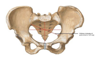 <p>The oblique diameter of the pelvic inlet extends from _</p>
