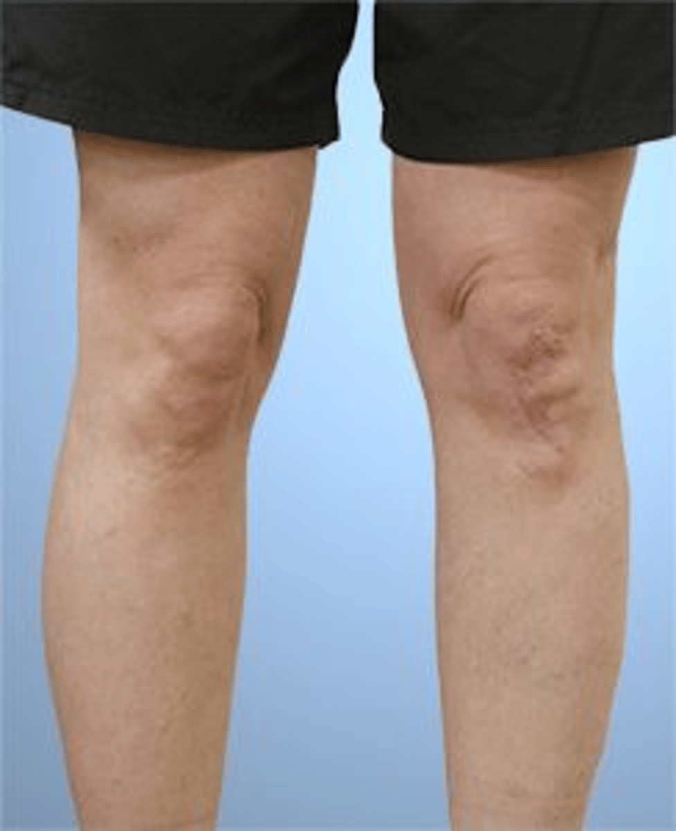 <p>4,4</p><p>1. A long patellar tendon could result in a height change of the patella, but the patella would not appear to be facing inward ("squinting patella") as shown in the photograph. An inward patella ("squinting patella") could indicate femoral anteversion.</p><p>2. A long patellar tendon could result in a height change of the patella, but the patella would not appear to be facing inward ("squinting patella") as shown in the photograph. An inward patella ("squinting patella") could indicate femoral anteversion.</p><p>3. The position of the patella appears inward ("squinting patella"), which could indicate femoral anteversion. In the photograph, the right patella appears to be facing inward, which suggests femoral anteversion, not retroversion.</p><p>4. The position of the patella appears inward ("squinting patella"), which could indicate femoral anteversion. In the photograph, the right patella appears to be facing inward, which suggests femoral anteversion and medial (internal) tibial rotation</p>