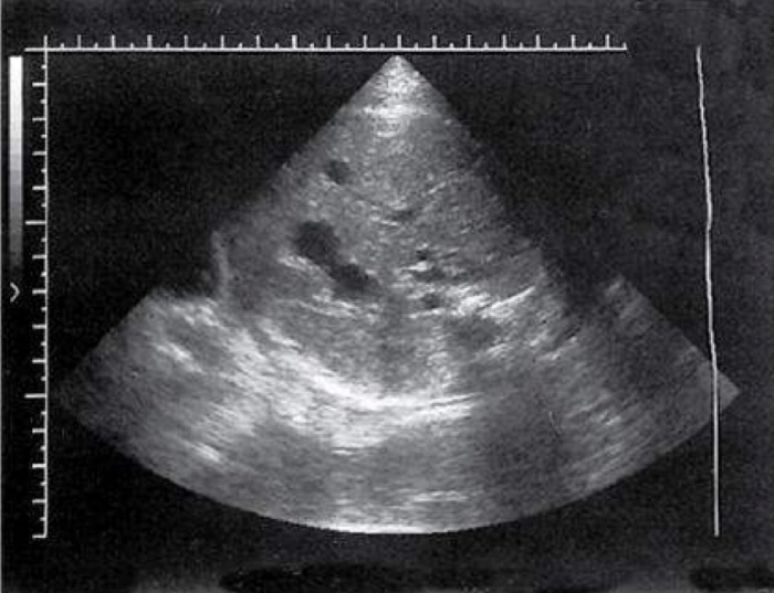 <p>Between 12-24 weeks of gestation, spleen functions as hematopoietic organ; sonographic appearance comparable to fetal liver (mid-gray and homogeneous with indistinct margins during early development</p>
