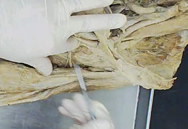 <p>Behind femoral nerve and lateral to femoral arteries and veins</p>