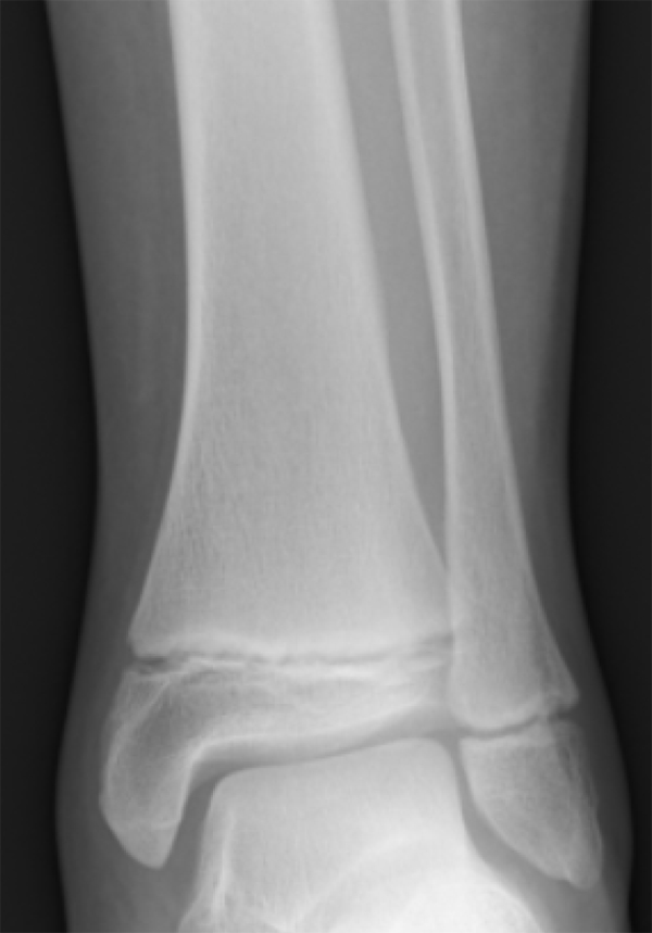 <p>What is this and is this an adult or children bone</p>