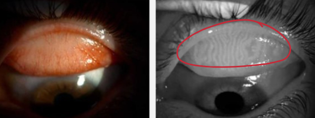 <p>identify the meibomian flands of eyelid </p>