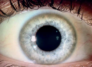 <p>low ALP + AST:ALT high (up to 4:1) in a young patient</p>