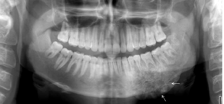<p>osteosarcoma radiographic features</p>