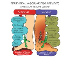 <p>peripheral vascular disease</p>