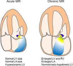 <p>3b Apex, Early Systolic murmur </p><p><span data-name="arrow_right" data-type="emoji">➡</span> Acute Mitral Regurgitation</p>
