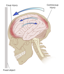 <p>Where are contusions most common and why?</p>