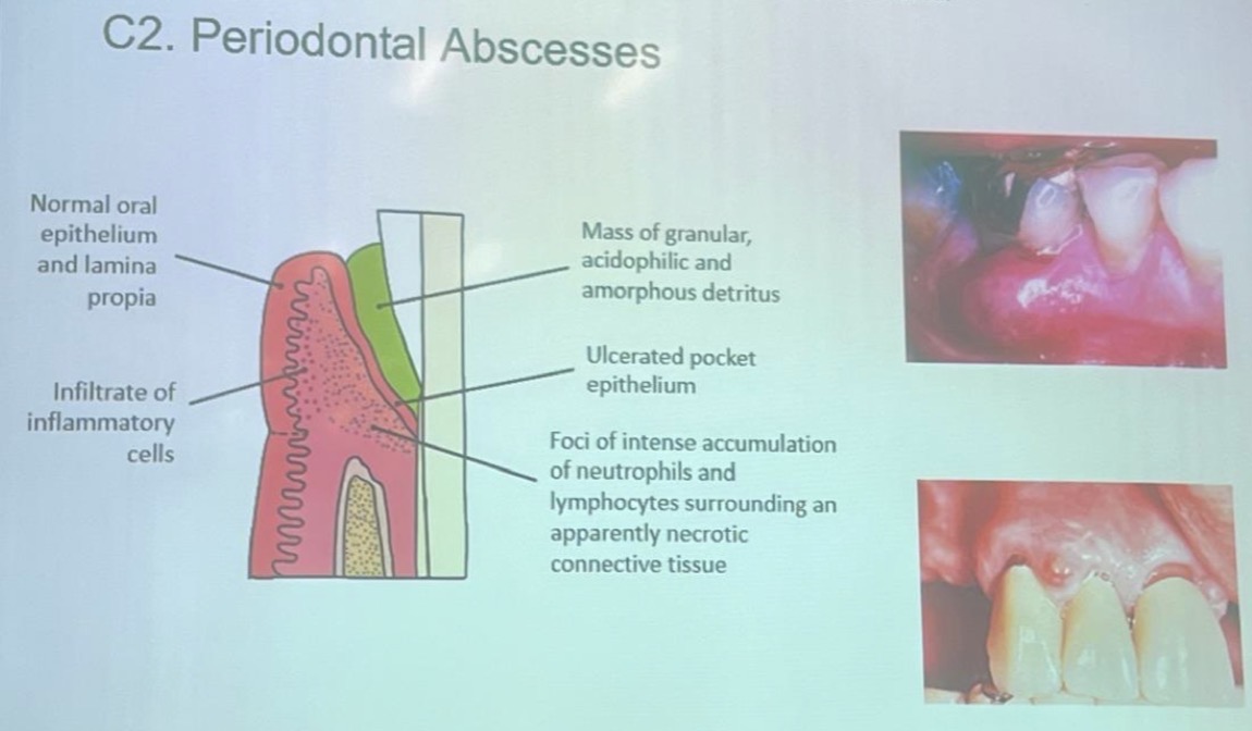 <p>C2- periodontal abscess classification </p>