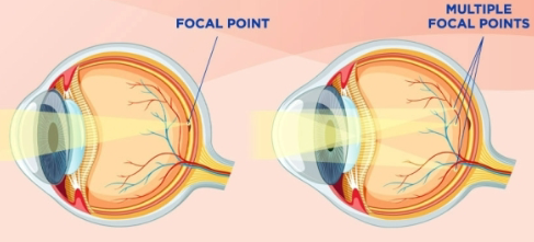 <p>Cornea or lens has an uneven curvature and uneven light curvature</p>