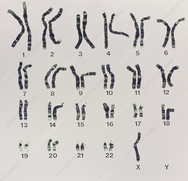 <p>What does the following karyotype show?</p><p>a) Patau syndrome</p><p>b) Pallister-Killian syndrome</p><p>c) Turner syndrome</p><p>d) Down syndrome</p>