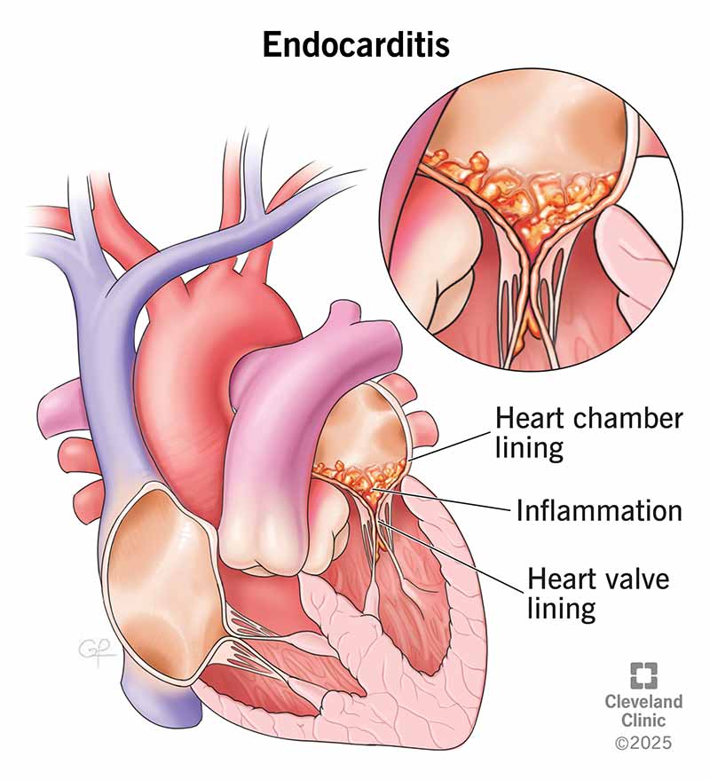 <p>Infection of endocardium &amp; heart valves ; often occurs w/ those who use IV drugs…</p><p>i.) Blood flows rapidly from high-pressure to low-pressure zone → erodes endocardium</p><p>ii.) Platelets and fibrin adhere → form vegetative lesion </p><p>iii.) Bacteria trapped during bacteremia → deposited in vegetation </p><p>iv.) Vegetation grows → destroys endocardium &amp; valve </p><p>v.) <em>Valvular insufficiency or stenosis results </em></p><p>vi.) <em>Vegetations may</em><strong><em> </em></strong><em>embolize into systemic circulation</em></p>