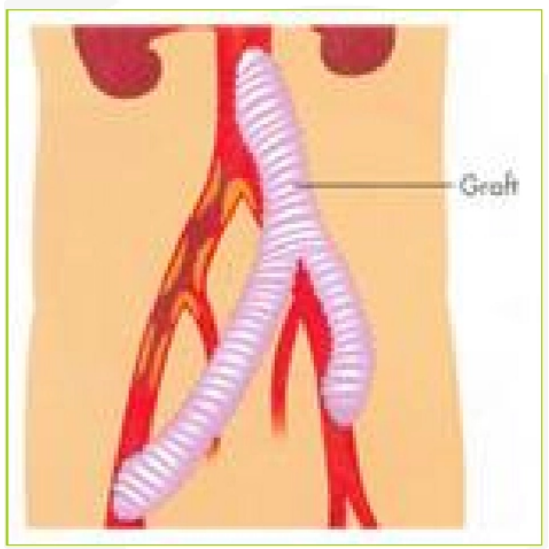 <ul><li><p>vascular pathology remains</p></li><li><p>end to side anastomosis</p></li><li><p>eg occlusive diseases</p></li></ul><p></p>
