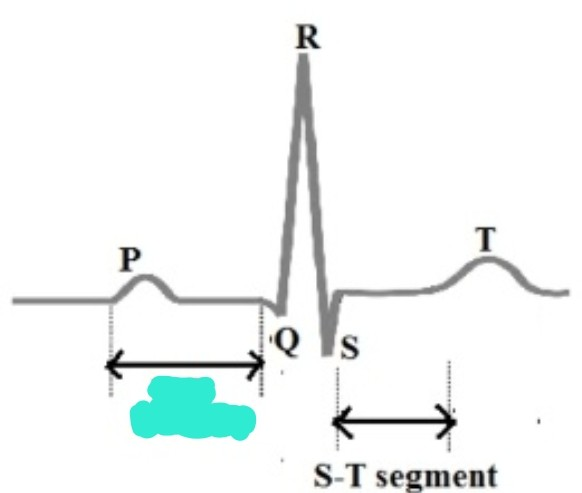 <p>P wave 시작 에서 QRS complex 전까지 기간</p><p>-PR interval 연장이면 atrium→ventricle 신호 전달 속도 느림</p>