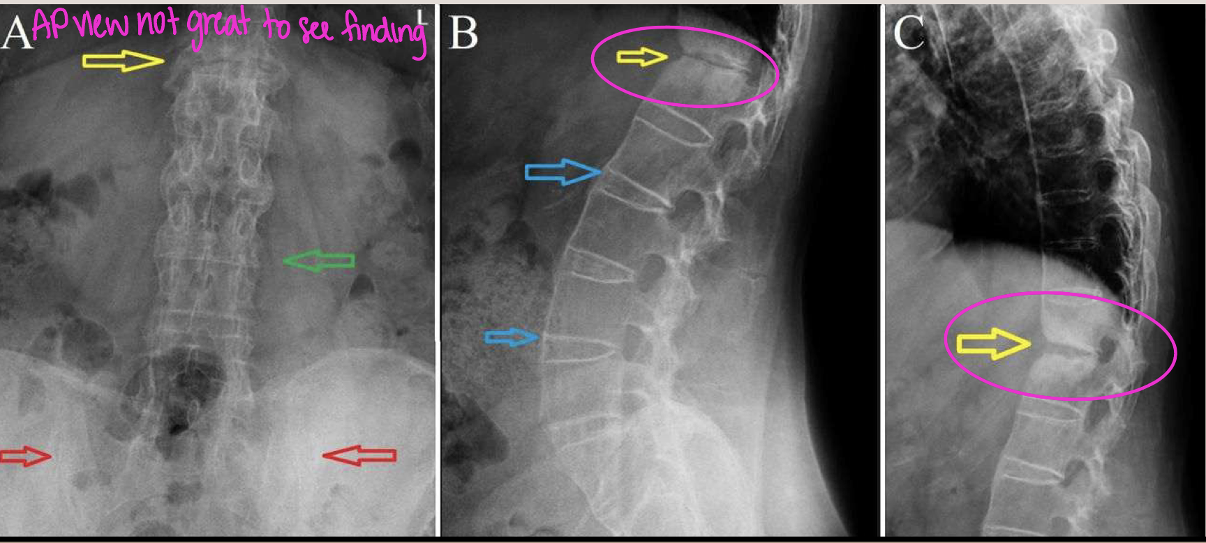 <p>What finding of AS is found in this image</p>