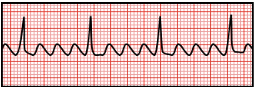 <p>what dysrhythmia is this </p>