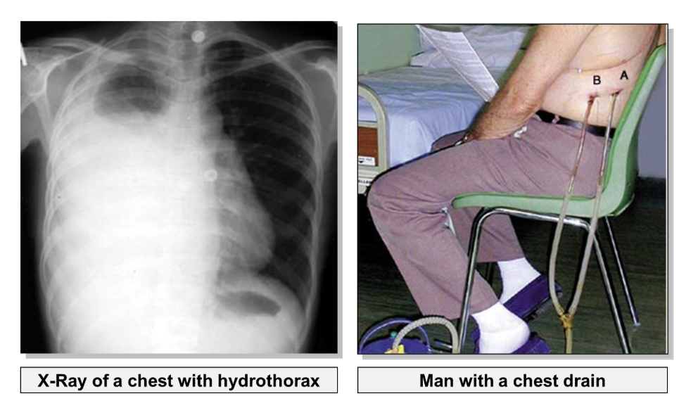 <p>In order to re-inflate the lung, fluid must be <strong>drained </strong>from the pleural cavity using a chest drain.</p>
