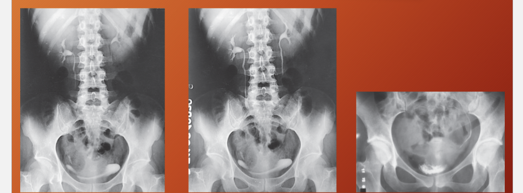 <p>which one is postvoid</p>