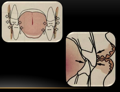 <p>-teeth will not stay where muscle does not want them to be</p><p>-if outward horizontal forces from the tongue are greater than the inward forces exerted by the buccinator muscle bands and the lips, the teeth will move horizontally until opposing forces are equal</p>