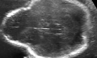 <p>tri-lobed appearance of the head</p><ul><li><p>associated with <strong>thanatophoric dysplasia </strong>and <strong>homozygous achondroplasia </strong></p></li></ul><p></p>