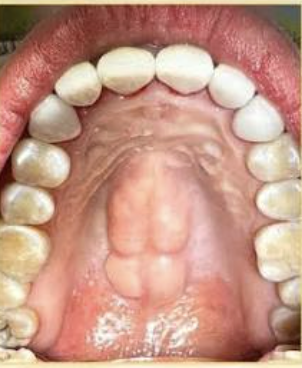<p>Hard palate: torus palatinus (palatine torus) </p>