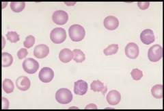 <p>Mixture of normochromic &</p><p>hypochromic RBCs. dimdorphic anemia, post-transfusion</p>