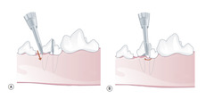 <p>Which image shows the wedge/luxator? Which image shows elevator/lever?</p>