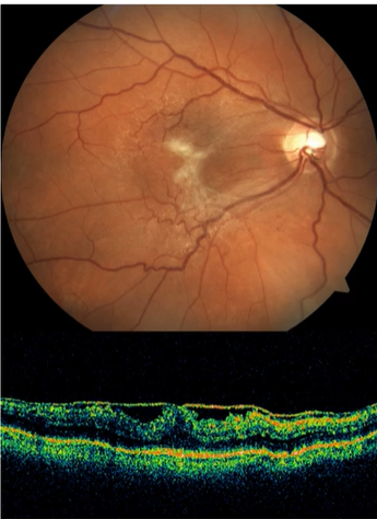 <ul><li><p>Symptoms</p><ul><li><p>Largely asymptomatic</p></li><li><p>May present with decreased and distorted vision (glare)</p><ul><li><p>Changes over time-memb is contractile-metamorphopisa at diff levels</p></li></ul></li><li><p>Often bilat</p></li></ul></li><li><p>Causes</p><ul><li><p>Idiopathic</p></li><li><p>Retinal break</p></li><li><p>Retinal detachment</p></li><li><p>Laser photocoagulation</p></li><li><p>Ocular surgery</p></li><li><p>Trauma</p></li><li><p>Intraocular inflammation</p></li><li><p>Diabetic retinopathy</p></li><li><p>Other retinal vascular diseases</p></li></ul></li><li><p>Clinical signs</p><ul><li><p>Glistering membrane (cellophane maculopathy)</p></li><li><p>Thick grey membrane (macular pucker)</p></li><li><p>Retinal folds</p></li></ul></li><li><p>Management</p><ul><li><p>Membrane peeling =more common in Germany than UK</p><ul><li><p>risks=not done freq</p></li></ul></li></ul></li></ul><p></p>