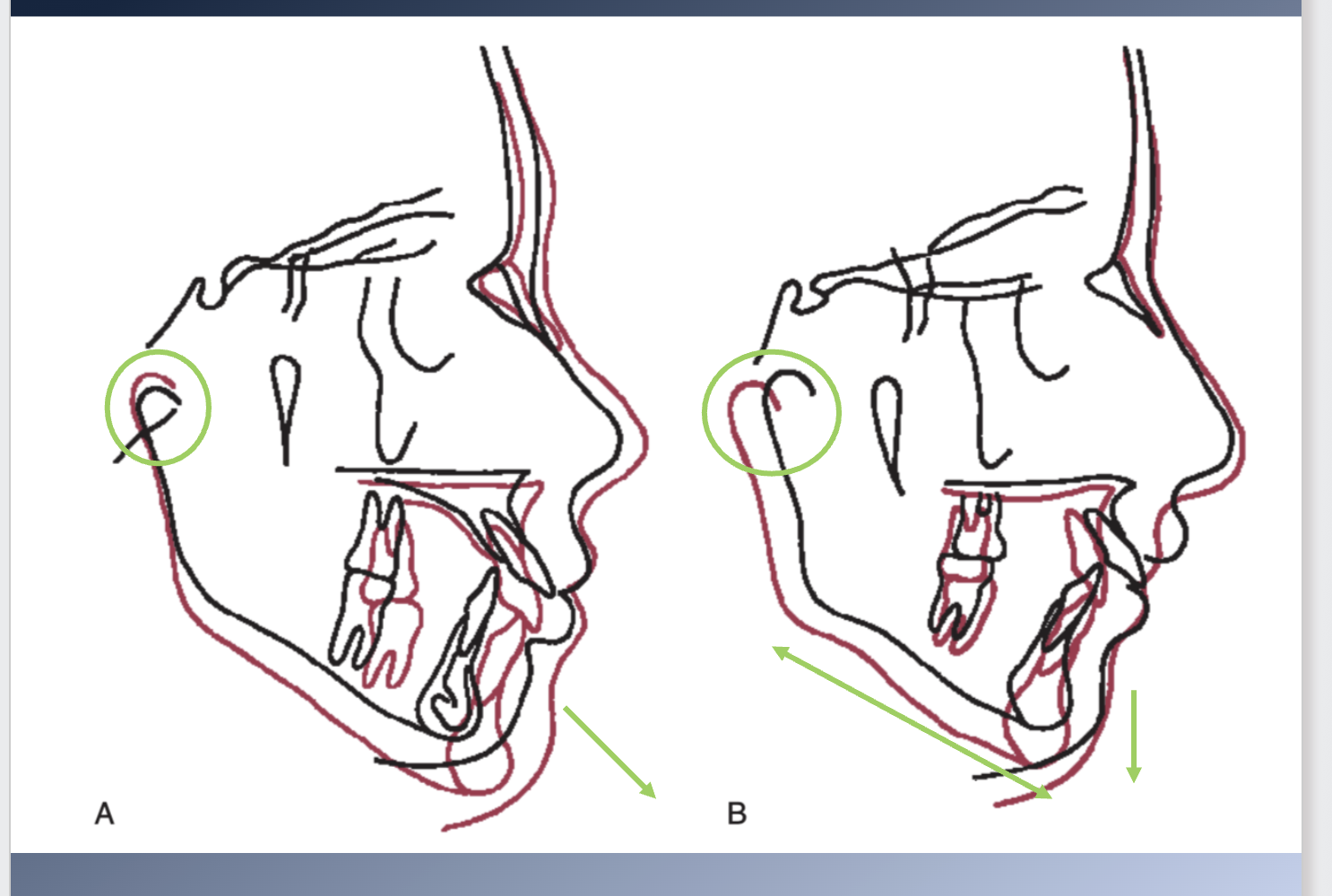 <p><span>Changes in the glenoid fossa</span><br><span>Great variability also due to growth changes in the glenoid fossa</span><br><span>1. Attachment point (glenoid fossa in temporal bone) moves usually straight down</span><br><span>2. No anteroposterior displacement of the mandible, although occasiolly it moves posteriorly à reducing the forward projection of the chin</span></p>