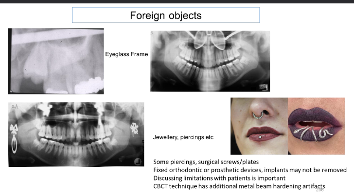 <p>-Must remove removable metal before imaging pr a retake may be needed</p>