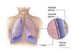 <p>disorders that involve the pleural space</p>