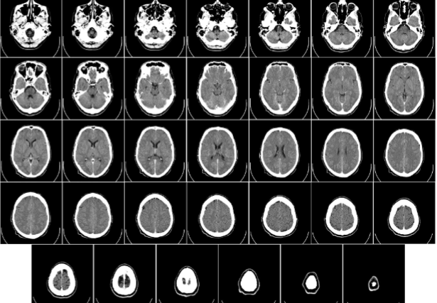 <p>thin x-ray beam with detector on opposite side of patient, rotates and translates to build a 3D image, distinguishes white matter, grey matter, and ventricles, good to distinguish injuries and tumors, cheaper and easier than MRI</p><p>limitations: contrast and resolution in brain is worse than MRI, only certain angles, significant radiation dose (~100x greater than standard x-ray)</p>