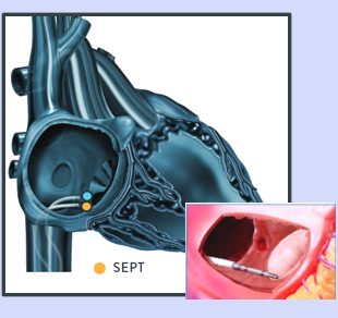 <p>SEPT (right sided)</p>