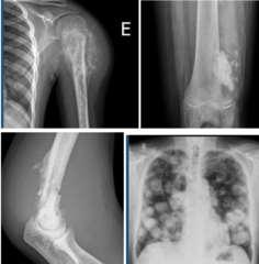<p>What is this?</p><p>- 10-25 yo, Male</p><p>- Pain (Painful swelling, Hx of antecedent trauma)</p><p>- Metaphysis around the knee (Distal femur, proximal tibia) + Proximal Humerus</p>