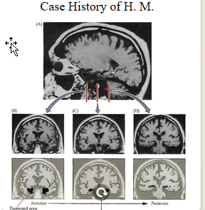 <p>MRI scan of H.M. brain: Patient sustained a large bilateral resection of the medial temporal lobes including entorhinal cortex, most of perirhinal cortex, amygdala &amp; about half of hippocampus  in an effort to relieve severe epilepsy that resulted in profound impairment in retaining and recollecting new information.</p>