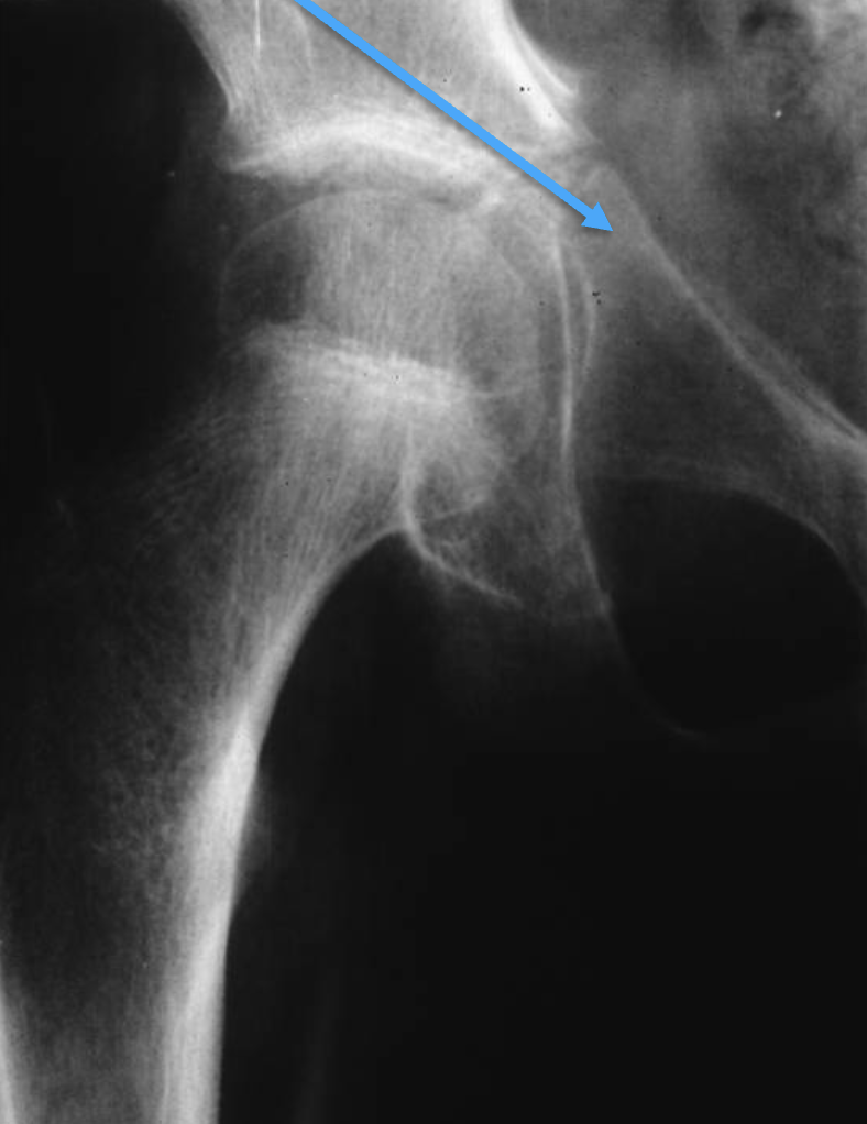 <p>What tumour-like condition is this, what bone is it in and what can be seen?</p>