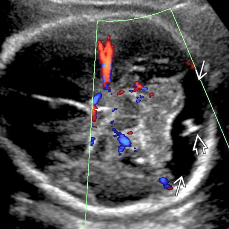 <p>Enlargement of the cisterna magna greater than 10 mm </p><p>Normal cerebellum and fourth ventricle</p>