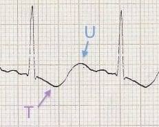 <p>Prominent U wave</p>