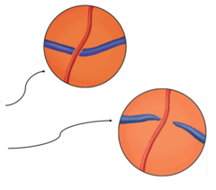<p>vein appears to taper down in diameter on either side of the artery</p><p>(common in hypertensive patients where arterial walls lose transparency)</p>