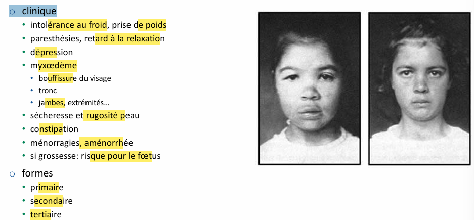 <p>Cause: déficit en iode (goitre en endémique), dim synthèse et sécrétion de T4-3 avec:</p><ul><li><p>Thyroïdite d'Hashimoto</p></li><li><p>Hypothyroïdie congénitale et iatrogene</p></li></ul><p>Biochimie; TSH +++ et FT4   (FT3 -)</p><p></p>