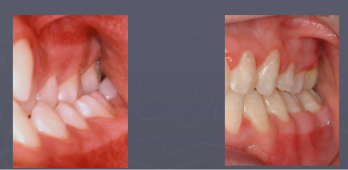 <p>Stability of posterior crossbite correction b y upper arch expansion is reliant on what?</p>